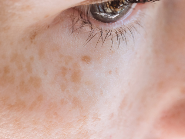 CLOSE UP SHOT OF PIGMENTATION ON SKIN