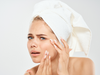 The Top 5 Products to Prevent & Treat Acne